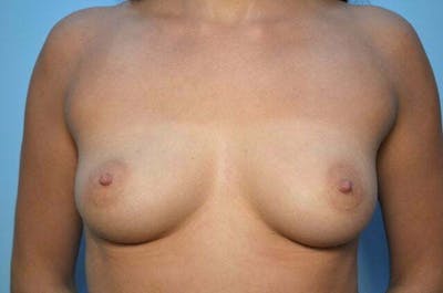 Breast Augmentation Before & After Gallery - Patient 325665 - Image 1