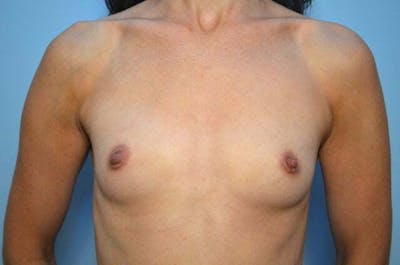Breast Augmentation Before & After Gallery - Patient 278924 - Image 1