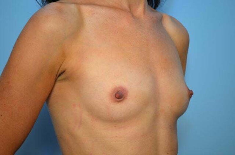 Breast Augmentation Before & After Gallery - Patient 278924 - Image 3