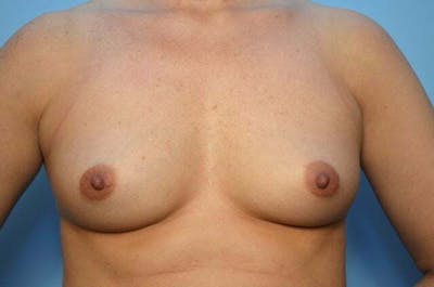Breast Augmentation Before & After Gallery - Patient 424685 - Image 1