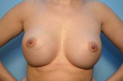 Breast Augmentation Before & After Gallery - Patient 424685 - Image 2