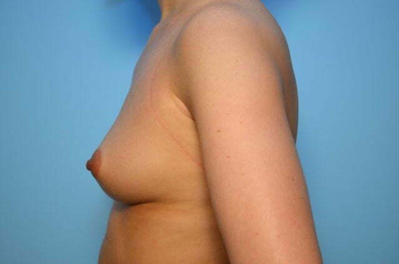 Breast Augmentation Before & After Gallery - Patient 424685 - Image 9