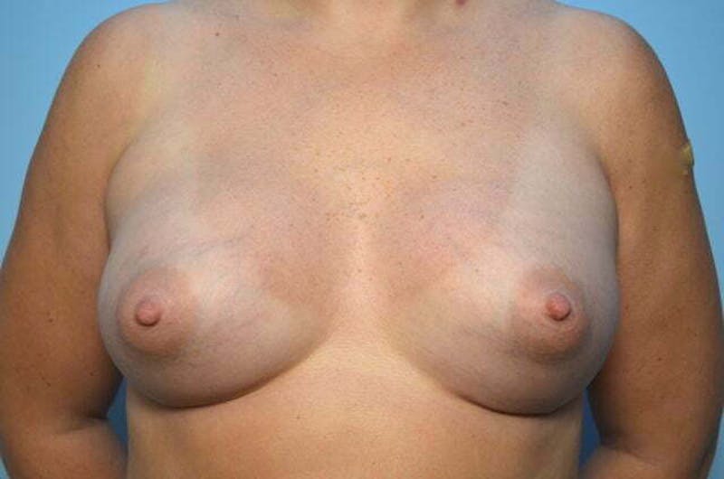 Breast Augmentation Before & After Gallery - Patient 324303 - Image 2