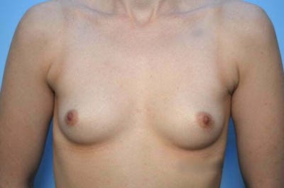 Breast Augmentation Before & After Gallery - Patient 115203 - Image 1