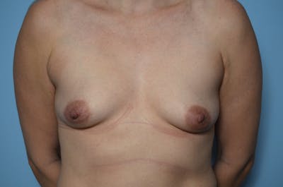 Breast Augmentation Before & After Gallery - Patient 905643 - Image 1