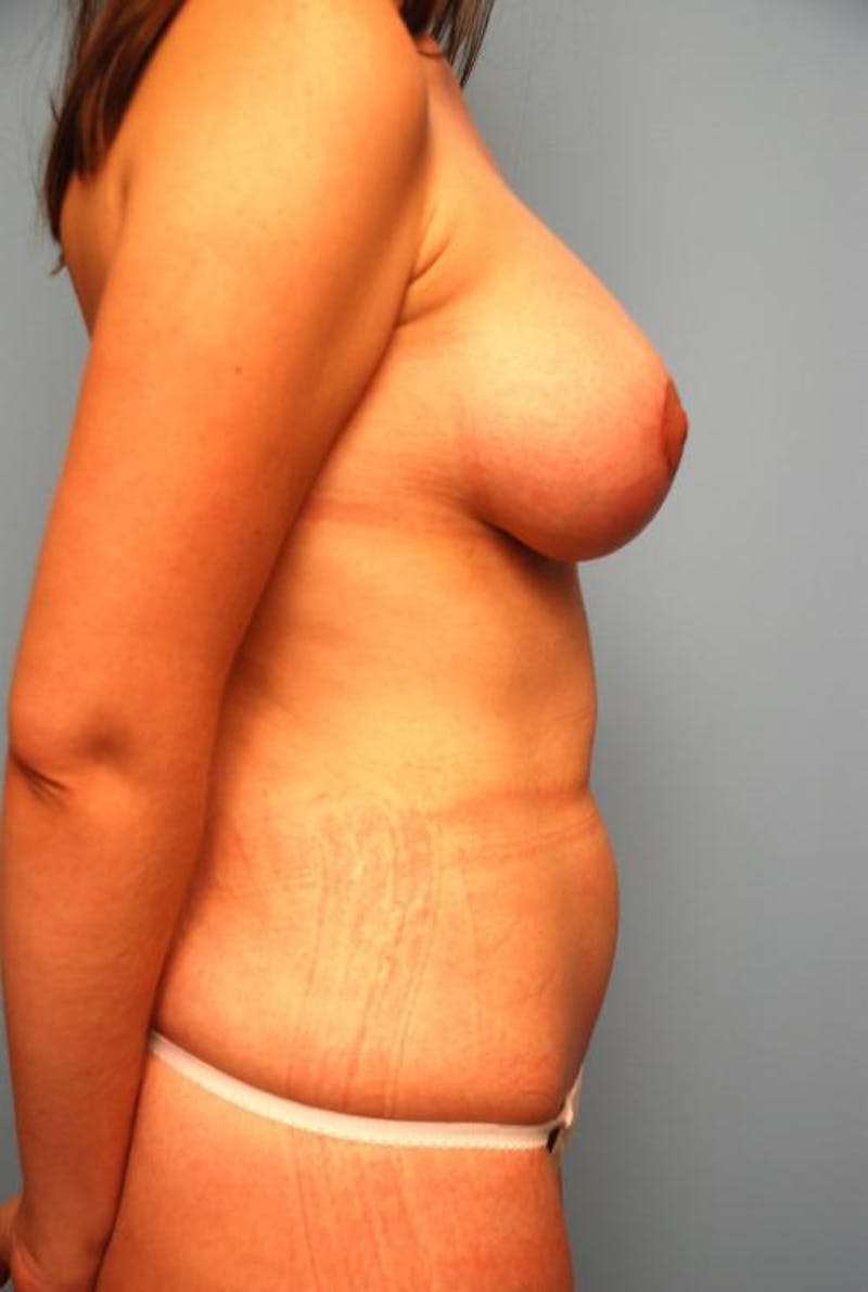 Liposuction Before & After Gallery - Patient 220412 - Image 6