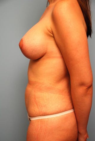 Liposuction Before & After Gallery - Patient 220412 - Image 10