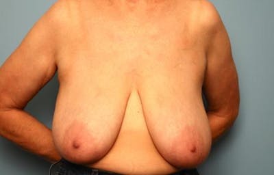 Breast Augmentation and Lift Before & After Gallery - Patient 350781 - Image 1
