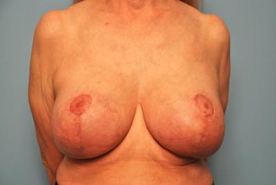 Breast Augmentation and Lift Before & After Gallery - Patient 350781 - Image 2