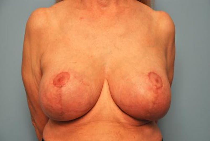 Breast Lift with Augmentation Before & After Gallery - Patient 402625 - Image 2