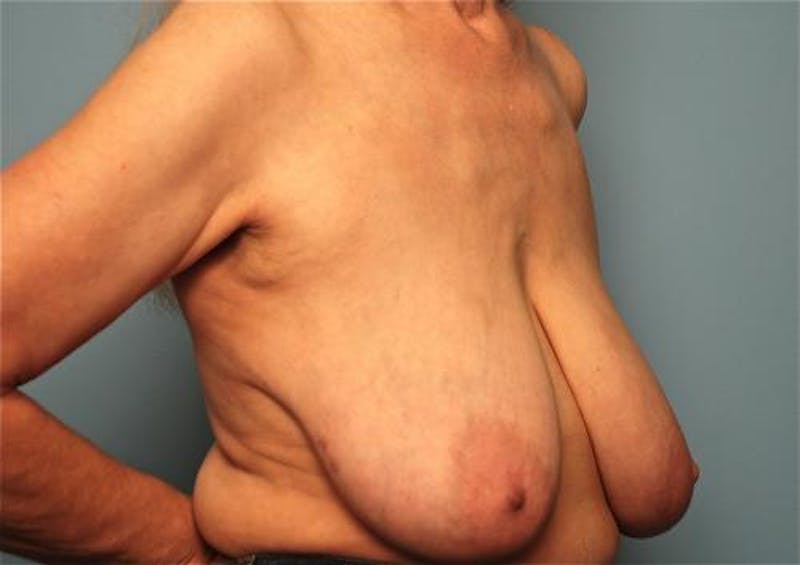 Breast Lift with Augmentation Before & After Gallery - Patient 402625 - Image 3
