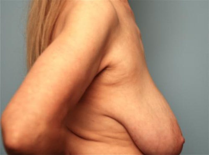 Breast Lift with Augmentation Before & After Gallery - Patient 402625 - Image 5