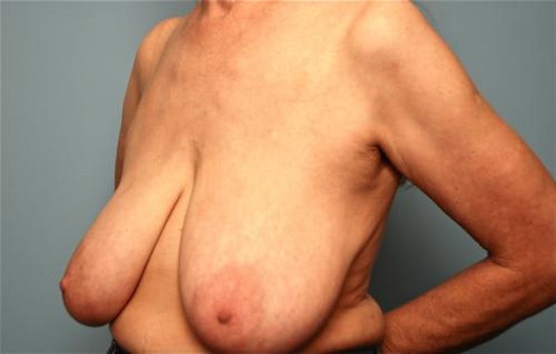 Breast Lift with Augmentation Before & After Gallery - Patient 402625 - Image 7