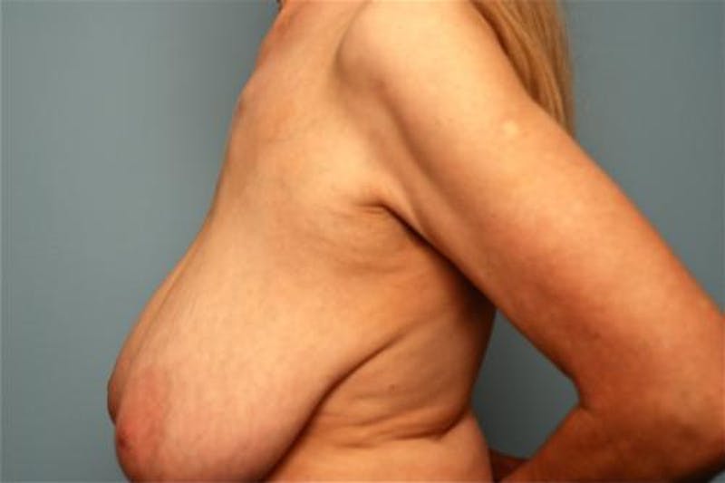 Breast Lift with Augmentation Before & After Gallery - Patient 402625 - Image 9