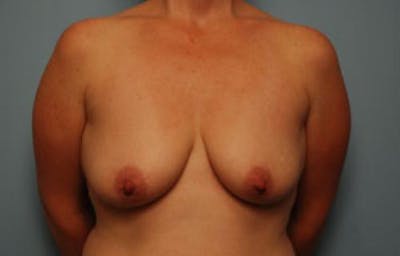 Breast Augmentation and Lift Before & After Gallery - Patient 914518 - Image 1