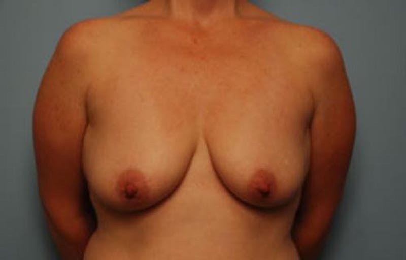 Breast Lift with Augmentation Before & After Gallery - Patient 427513 - Image 1