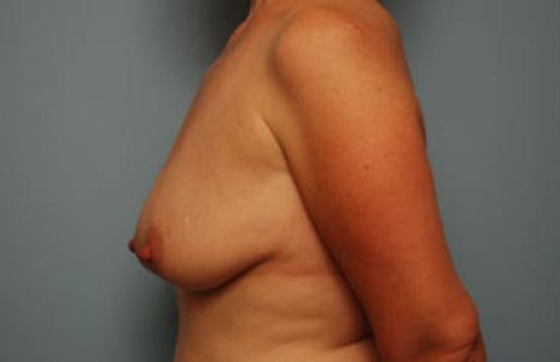Breast Lift with Augmentation Before & After Gallery - Patient 427513 - Image 5