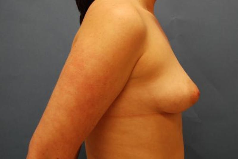 Tubular Breast Deformity Before & After Gallery - Patient 100482 - Image 5