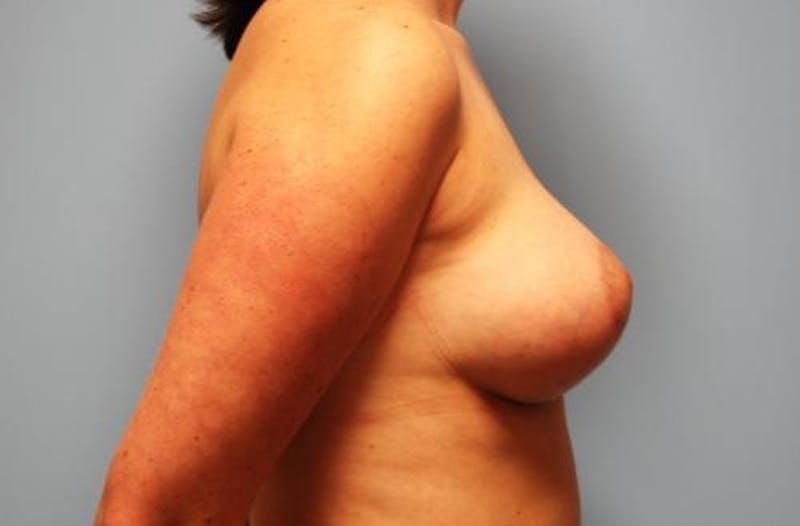 Tubular Breast Deformity Before & After Gallery - Patient 100482 - Image 6