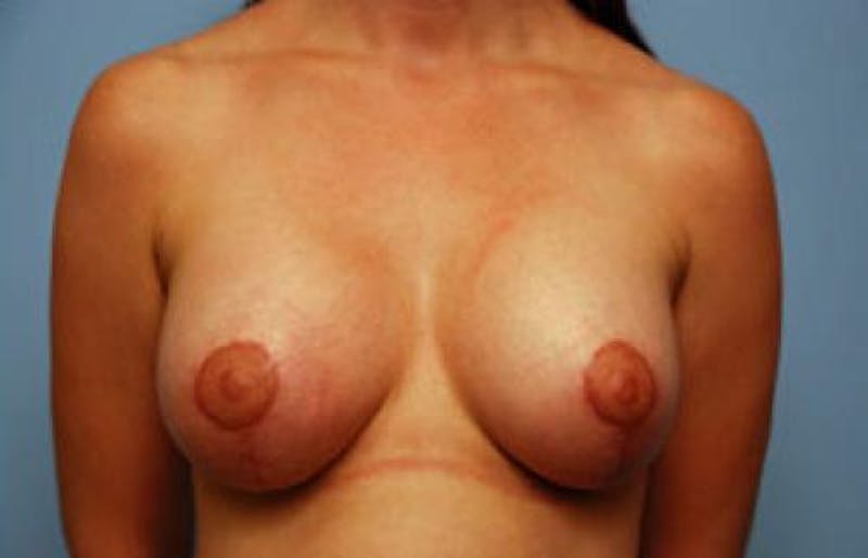 Breast Lift with Augmentation Before & After Gallery - Patient 784210 - Image 2