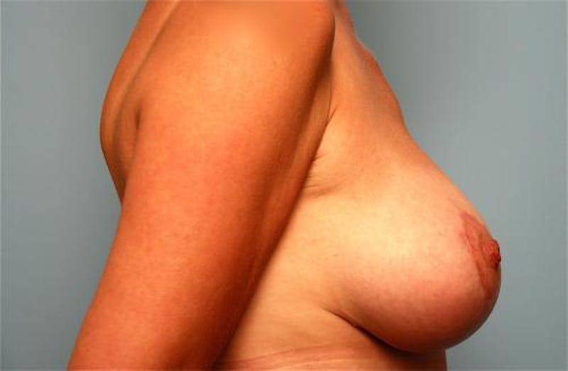 Breast Lift with Augmentation Before & After Gallery - Patient 115553 - Image 6