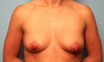 Breast Augmentation and Lift Before & After Gallery - Patient 285056 - Image 1