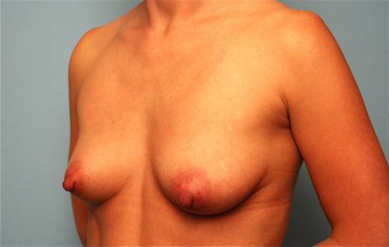Breast Lift with Augmentation Before & After Gallery - Patient 203413 - Image 7