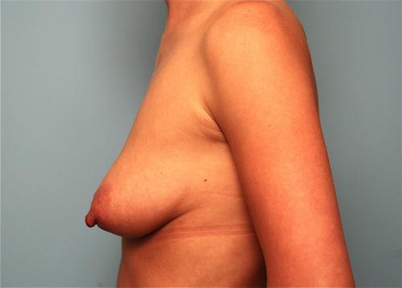 Breast Lift with Augmentation Before & After Gallery - Patient 203413 - Image 9