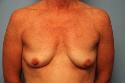 Breast Augmentation and Lift Before & After Gallery - Patient 397511 - Image 1