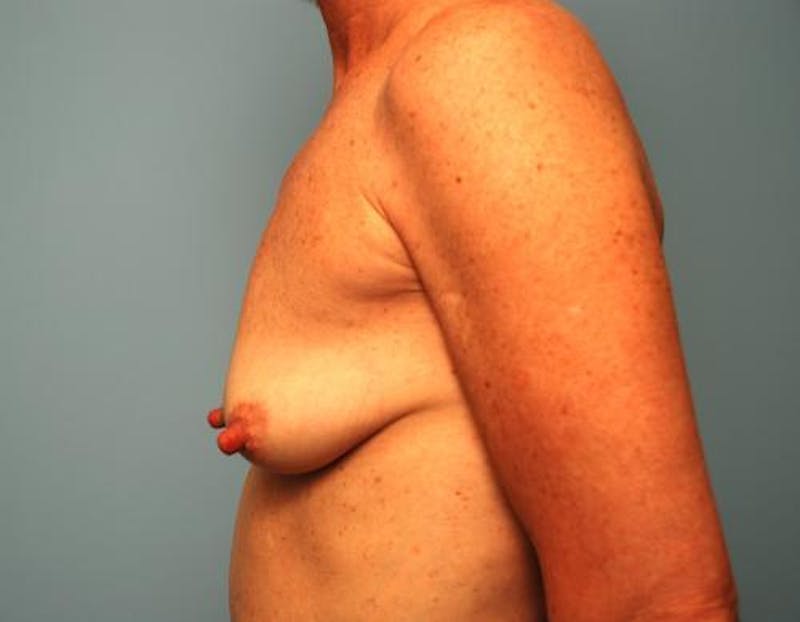 Breast Lift with Augmentation Before & After Gallery - Patient 145129 - Image 9