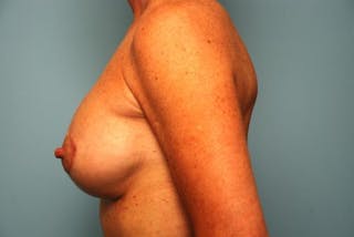 Breast Lift with Augmentation Before & After Gallery - Patient 145129 - Image 10