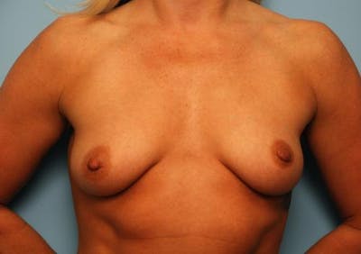 Breast Augmentation and Lift Before & After Gallery - Patient 930928 - Image 1