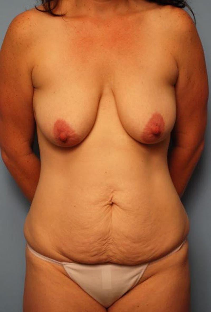 Tummy Tuck Before & After Gallery - Patient 150596 - Image 1