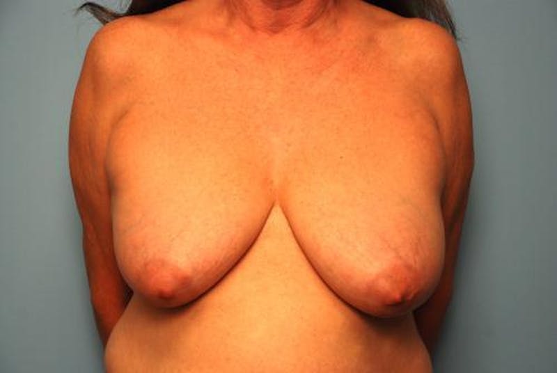 Breast Lift with Augmentation Before & After Gallery - Patient 350713 - Image 1
