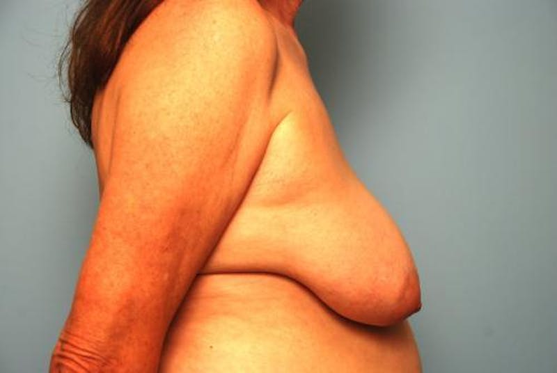 Breast Lift with Augmentation Before & After Gallery - Patient 350713 - Image 5
