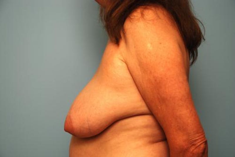 Breast Lift with Augmentation Before & After Gallery - Patient 350713 - Image 9