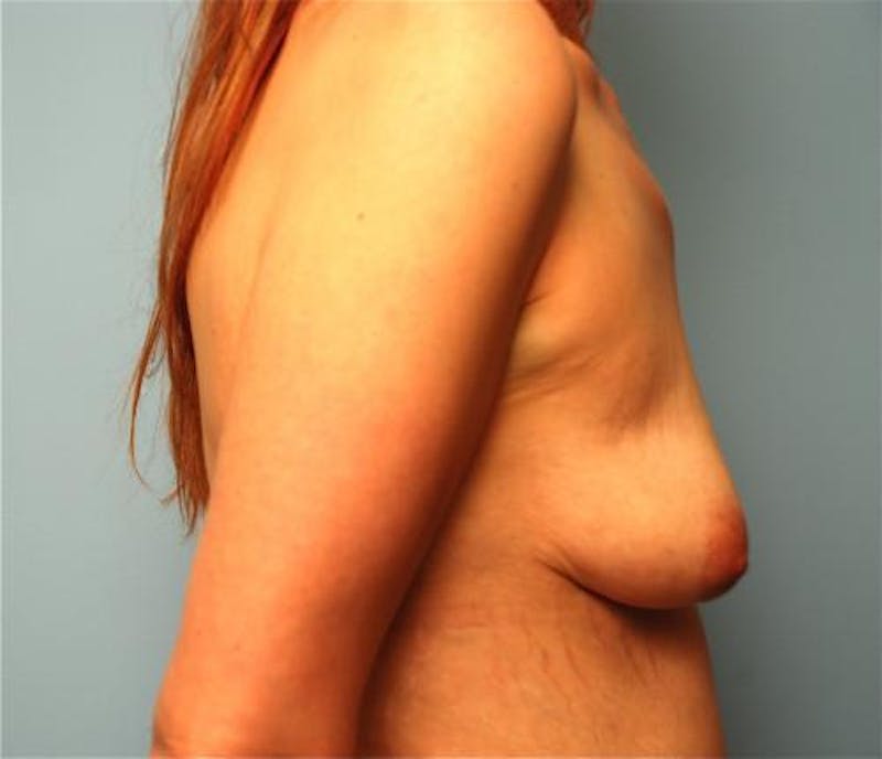Breast Lift with Augmentation Before & After Gallery - Patient 336754 - Image 5