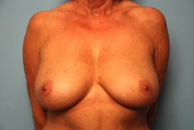 Breast Augmentation and Lift Before & After Gallery - Patient 385904 - Image 1