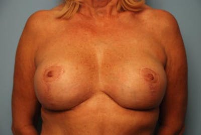 Breast Augmentation and Lift Before & After Gallery - Patient 385904 - Image 2