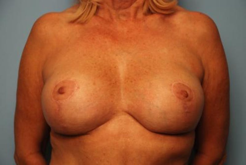 Breast Lift with Augmentation Before & After Gallery - Patient 502409 - Image 2