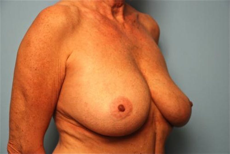 Breast Lift with Augmentation Before & After Gallery - Patient 502409 - Image 3