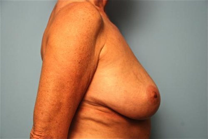 Breast Lift with Augmentation Before & After Gallery - Patient 502409 - Image 7