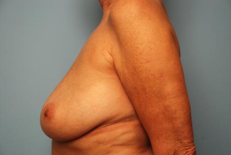 Breast Lift with Augmentation Before & After Gallery - Patient 502409 - Image 9
