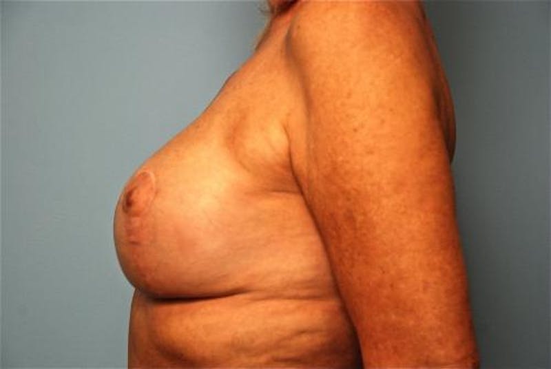 Breast Lift with Augmentation Before & After Gallery - Patient 502409 - Image 10