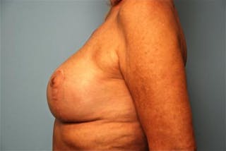 Breast Lift with Augmentation Before & After Gallery - Patient 502409 - Image 10