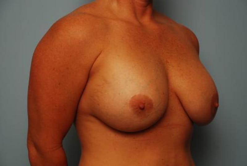 Breast Lift with Augmentation Before & After Gallery - Patient 367854 - Image 3
