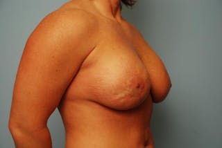Breast Lift with Augmentation Before & After Gallery - Patient 367854 - Image 4