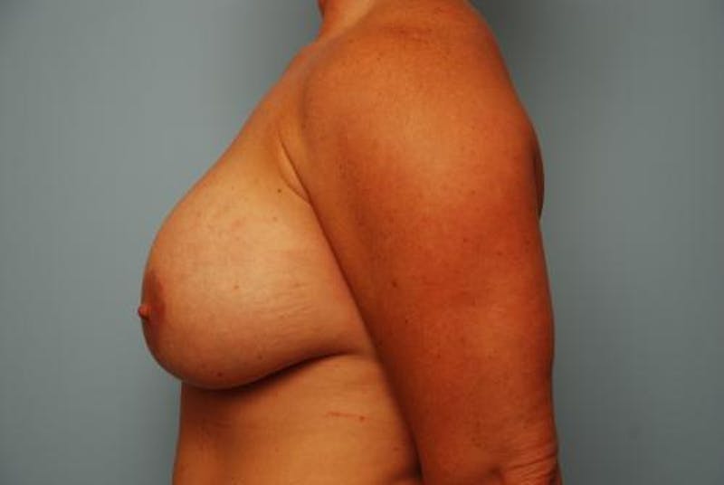 Breast Lift with Augmentation Before & After Gallery - Patient 367854 - Image 9