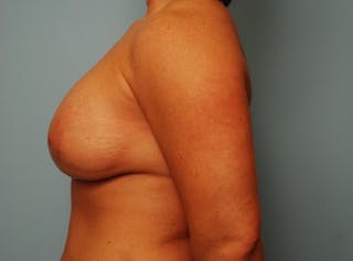 Breast Lift with Augmentation Before & After Gallery - Patient 367854 - Image 10