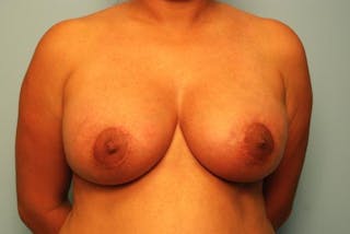 Breast Lift with Augmentation Before & After Gallery - Patient 587408 - Image 2